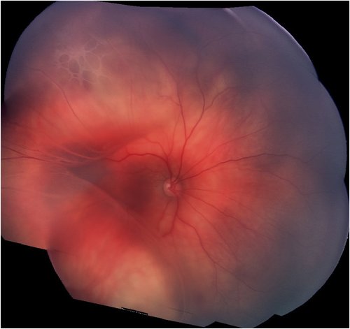 Retinoschisis