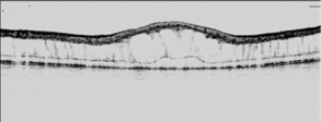 Retinoschisis