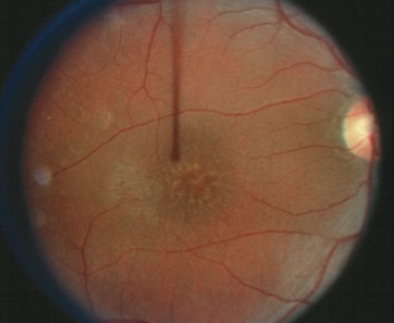 Retinoschisis