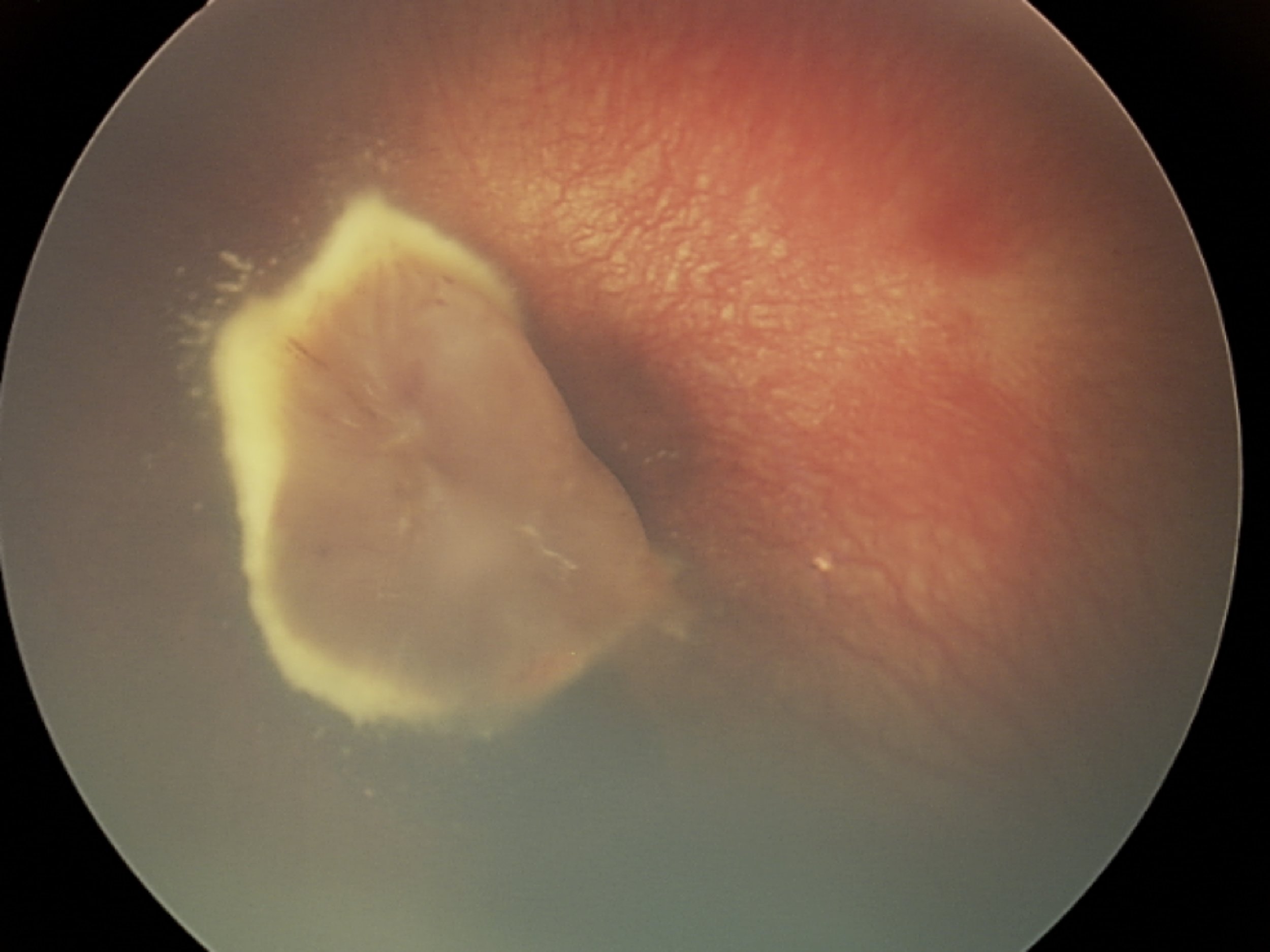 Norrie Disease