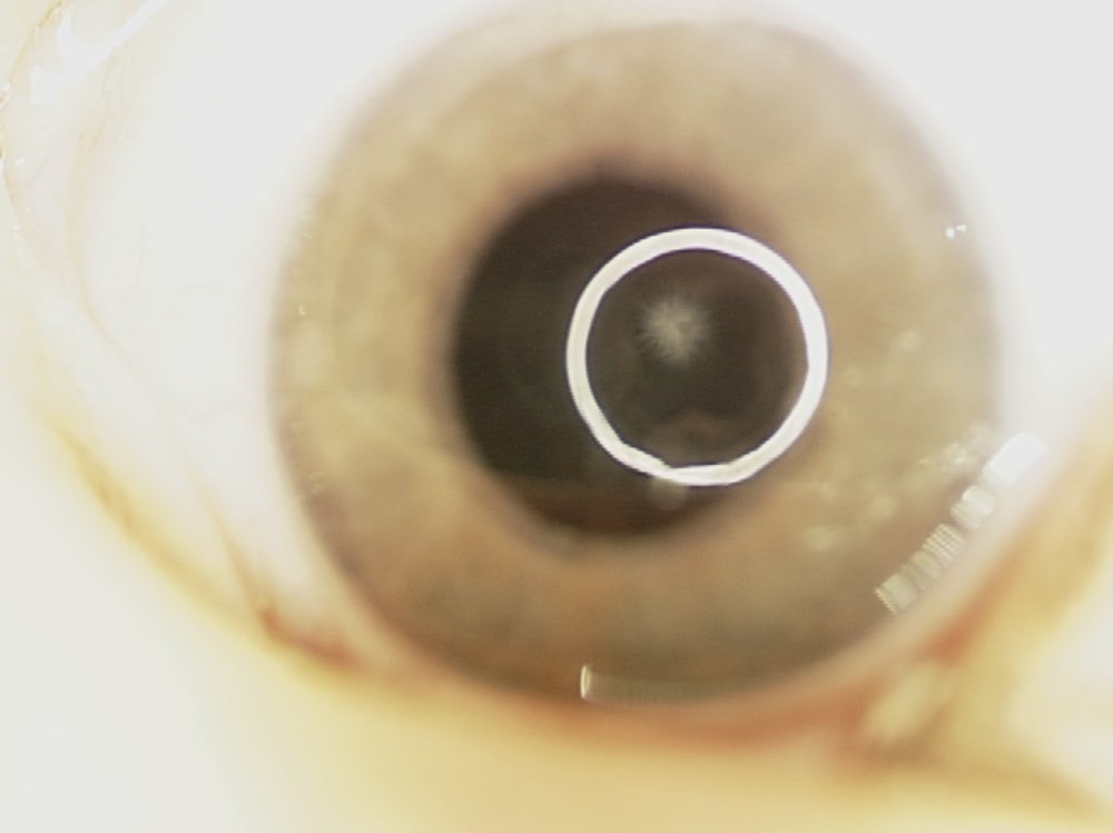 Persistent Fetal Vasculature Syndrome - “Brittle Star” lens opacity