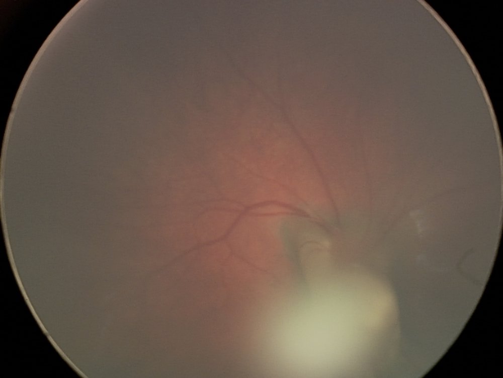 Persistent Fetal Vasculature Syndrome - stalk extending from the optic disc into the vitreous cavity towards the lens