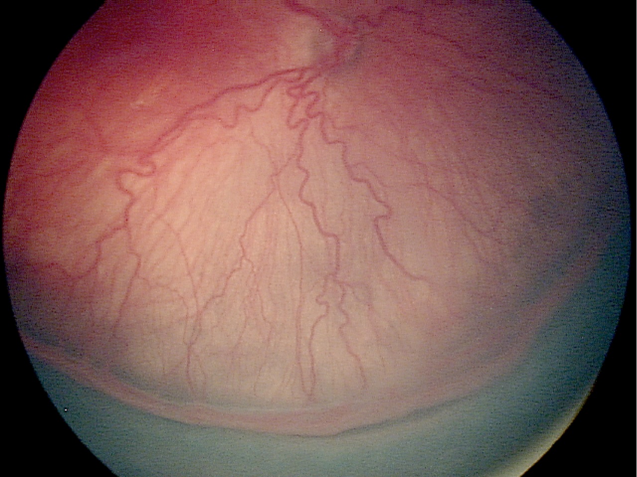Retinopathy of prematurity Stage 3 with plus disease