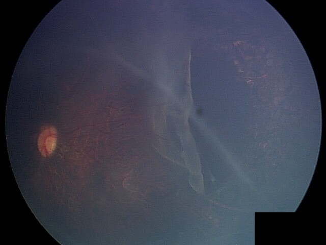 Stickler Syndrome w recurrent retinal detachment despite laser treatment