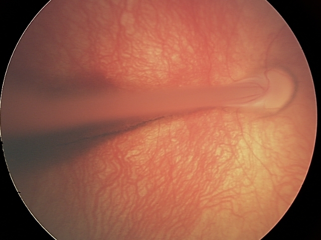 FEVR w Classic Retinal Fold