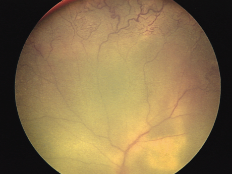 Image of eye: The characteristic vascular changes of Coats Disease are seen in the upper part of the retinal image. Whitish subretinal lipid is seen in the lower right.