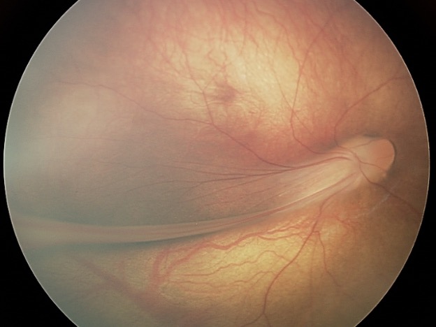 Image of eye: The retina is drawn into a fold by scar tissue.