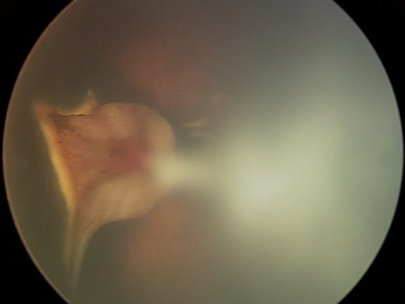 Photo of the eye: The poorly developed and disorganized retina appears as a whitish mass at the back of the eye. It is connected by a stalk to disorganized fibrovascular tissue at the front of the eye (out of focus).
