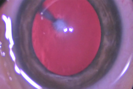 Image of the eye: The stalk tissue extends from the optic nerve in the back of the eye to the back of the lens as seen here.