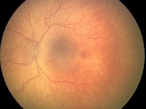 Image of eye: The peripheral retina is not vascularized in this image, with stage 1 ROP (a “demarcation line” positioned between the vascularized and non-vascularized retina) and dilated, tortuous vessels characteristic of “plus disease”.