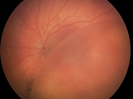 Eye image: The characteristic schisis cavity or “bulla” is seen in the lower right-hand side of this retinal image.