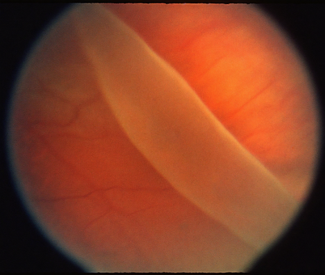 Image of Eye: A giant retinal tear is present to the upper left, with the detached edge of the retina rolled back over itself. (Image originally published in the Retina Image Bank® website. Author: Henry J. Kaplan, MD)